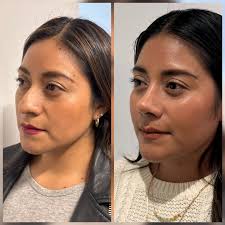 Fotografías de nuestra bella paciente a 4 meses de su rinoplastia  ultrasónica y estructural💯💯✔️✔️ En este caso nuestra paciente nos  solicitó una nariz natural y estilizada, se logró mejorar esta en todos