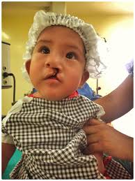 Dr.Gustavo Florez en Dr.Raul Rodriquez opereren schisiskinderen!