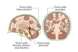 Maybe you would like to learn more about one of these? Kanker Otak Gejala Penyebab Dan Mengobati Alodokter