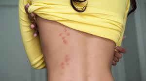 Image result for bedbugs bites