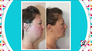 Shape, tighten and lift problem areas without extensive surgery