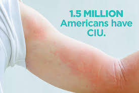 Hives That Won T Go Away The Basics Of Ciu Chronic Hives Chronic Idiopathic Urticaria Autoimmune Disease