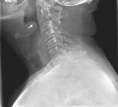 Image result for Epiglottitis