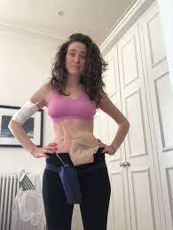 Stories highlight personal bowel cancer experiences, raise awareness of the signs and symptoms and can encourage and inspire others. Olivia Rowlands Never Too Young Bowel Cancer Uk