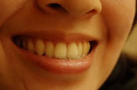 Check spelling or type a new query. Por Que Se Ponen Los Dientes Amarillos Clinica Cf