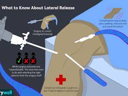 It plays an important role in patellar stability, and patellar instability can be caused by abnormal tension or tightness in the lpr  2 . Lateral Release Of The Patella Or Kneecap Realignment