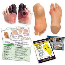 Image result for diabetic toes