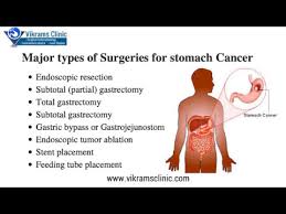 Learn more about the signs of stomach cancer, which can include upset stomach, indigestion, and staff, patients, and visitors must continue to wear masks while at msk, including people who are fully vaccinated. Stomach Cancer Treatment Gastric Cancer Treatment Stomach Cancer Cure Youtube