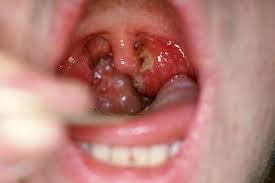 Image result for Strep throat infection roof of mouth