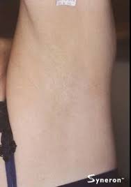 Laser hair removal at bareskin laser hair removal (up to 88% off). Laser Hair Removal Fairfield County Connecticut