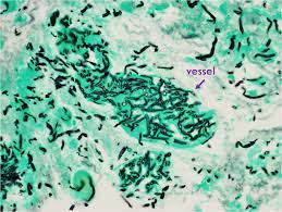 Clinical presentation the presentation can vary, ranging from exophthalmos, rhinorrhea, and ophthalmoplegia. Invasive Fungal Orbitorhinocerebral Mucormycosis Eyerounds Org Ophthalmology The University Of Iowa