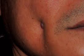 A comparative study// colorectal dis. Accidental Cheek Fistula British Dental Journal