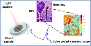 Inflammatory breast cancer is rare, accounting for 1 to 5 percent of all breast cancers. Characterization Of Inflammatory Breast Cancer A Vibrational Microspectroscopy And Imaging Approach At The Cellular And Tissue Level Analyst Rsc Publishing