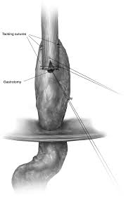The incisions are made in the neck, chest and abdomen (belly) to remove the esophagus and rebuild the gastrointestinal tract. Technique Of Open Ivor Lewis Esophagectomy Operative Techniques In Thoracic And Cardiovascular Surgery