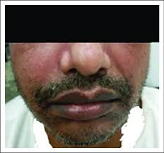 Extra-oral photo of a patient referred for 'gingivitis with early signs... 