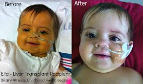 Biliary Atresia Awareness and Research.