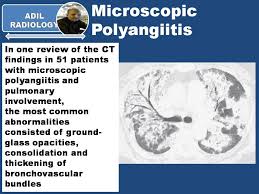 Image result for Microscopic Polyangiitis