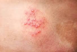 Image result for shingles in children