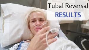 Can a tubal be reversed. Tubal Reversal Surgery The Results Trying To Conceive Youtube