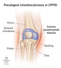 Image result for gout symptoms knee