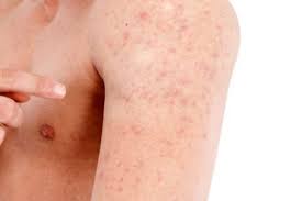 Keratosis pilaris is caused by excess keratin building up in your hair follicles, leading to hard, red, little bumps on your skin, says dermatologist mona gohara, md, associate clinical. 10 Keratosis Pilaris Treatment Ideas That Help Cure Chicken Skin