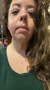 Where does radio frequency skin tightening ?