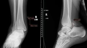 Image result for Subtalar Dislocation