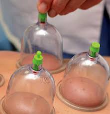 Massage Cupping and the Preacher