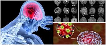 Check spelling or type a new query. Encefalitis Causas Tipos Sintomas Diagnostico Tratamiento Pronostico Prevencion Y Complicaciones Arriba Salud