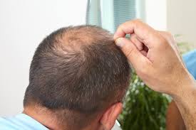 Brushing, touching, styling and sometimes even just laying down on a pillow can be uncomfortable and at times unbearable. Can Home Remedies Cure Baldness Hair Loss Restoration Replacement Connecticut