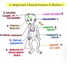 Image result for Craniotabes