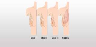 Ppt Male Breast Cancer Symptoms Diagnosis And Treatment Powerpoint Presentation Free To Download Id 867a11 Mze5m