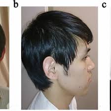 PDF) A novel small deletion in the NHS gene associated with Nance-Horan  syndrome