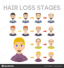 Information Chart Of Hair Loss Stages Types Of Baldness