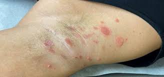 Image result for Impetigo