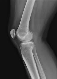 Image result for Knee XRay