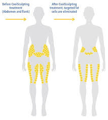 Pin On Body Contouring