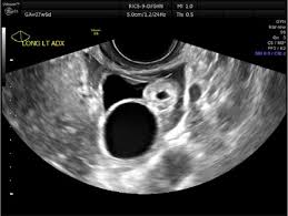 Image result for corpus luteum sonography)