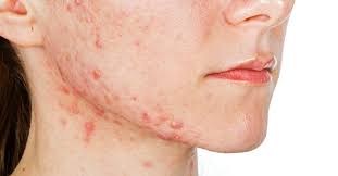 Just by doing these simple home remedies friends, you will be able to get rid of the acne/pimples on the chin area faster. Jawline Acne Causes Treatment And Prevention