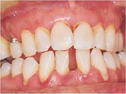 Gingivitis and periodontitis are inflammation of the gums and teeth respectively. Startup To Develop Periodontitis Vaccine Dentistry Today