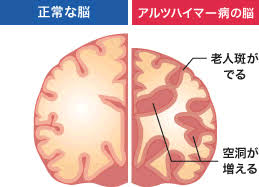 その他、 脳腫瘍、甲状腺機能低下症、栄養障害、薬物やアルコールに関連するもの など 早わかり三大認知症 アルツハイマー型認知症、レビー小体型認知症、血管性認知症それぞれの特徴を一覧表で比較しました。「認知症かしら？」と èªçŸ¥ç—‡ ãƒ‰ã‚¯ã‚¿ãƒ¼ S ã‚³ãƒ©ãƒ  Eoå¥åº·