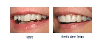 Izito.ws has been visited by 100k+ users in the past month Straighten Teeth Without Braces Or Invisalign Teethwalls