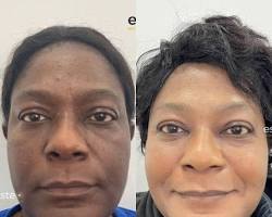 Image of Before and after photos of Cosmelan peel