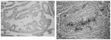 While diagnosis of mesothelioma has become much easier in recent years with the advent of new immunochemical markers, several cases still remain . Expression Of Facilitative Glucose Transport Proteins During Development Of Squamous Cell Carcinomas Of The Head And Neck Reisser 1999 International Journal Of Cancer Wiley Online Library