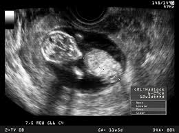 Ab wann wird der ultraschall über den bauch gemacht? 13 Ssw Schwangerschaftswoche Grosse Entwicklung 9monate De