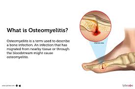 Image result for Osteomyelitis