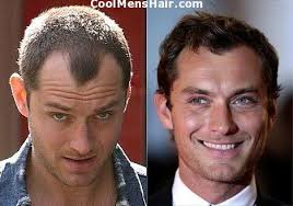 Restore your hair and your confidence. The Increasing Number Of Celebrity Hair Transplants Cool Men S Hair