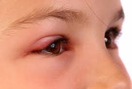One of the major reasons for puffy eyes in the morning in most people is because of no blinking during sleep. Pink Eye Conjunctivitis Symptoms Causes Treatments