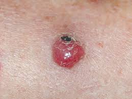 Image result for Merkel Cell Carcinoma
