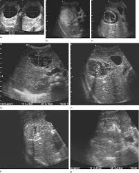 After 1 year of albendazole treatment, the cyst had converted to type 2 according to the gharbi classification (ce 3a according to the who classification) (fig. Percutaneous Treatment Of Hydatid Liver Cysts In Children As A Primary Treatment Long Term Results Journal Of Vascular And Interventional Radiology
